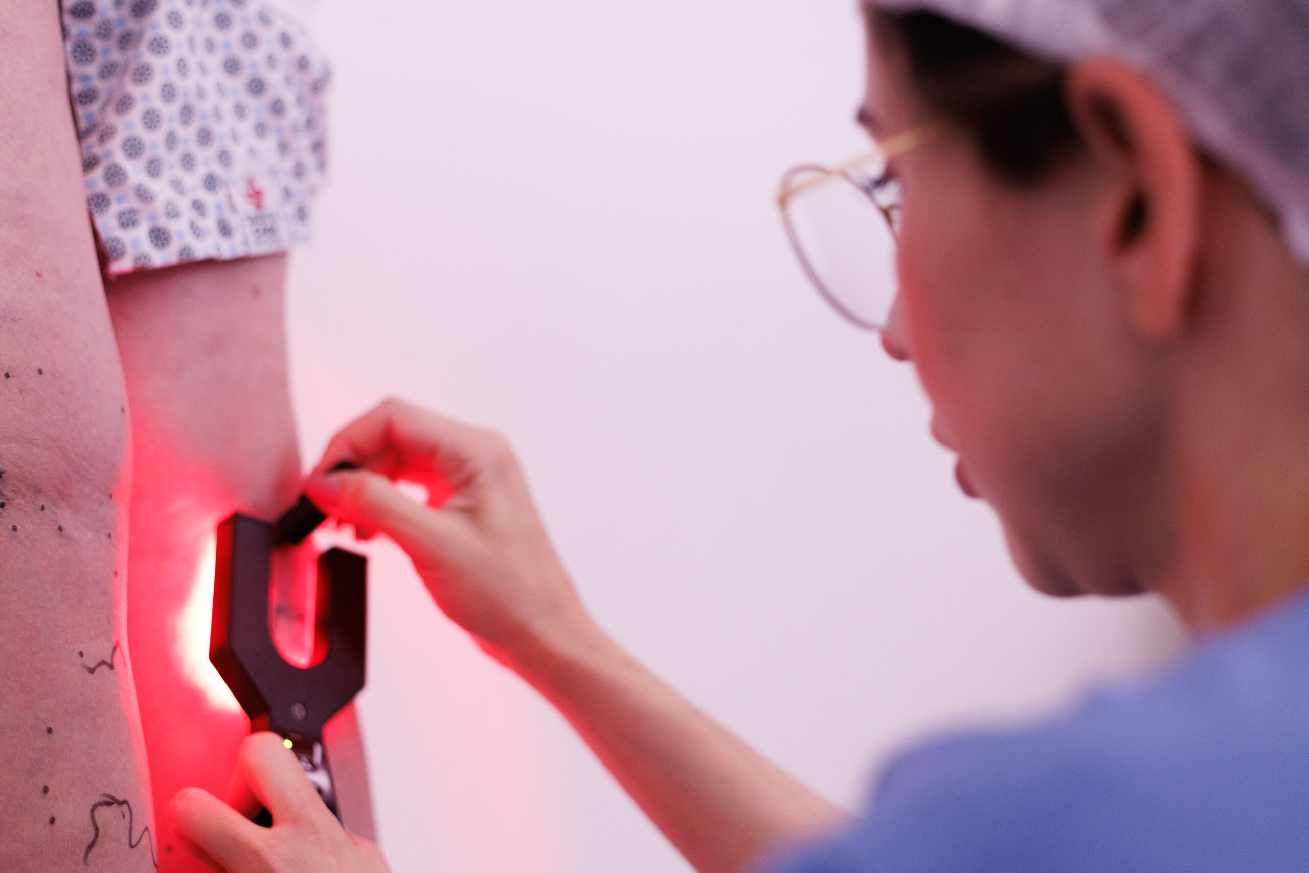 Escleroterapia com Espuma